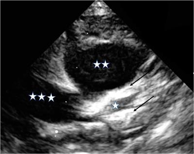 Have we got the optimal treatment for refractory Kawasaki disease in very young infants? A case report and literature review